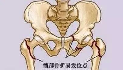 【老年友善·11】九旬老人骨折只能“卧以待毙”？高龄不再是骨科手术的禁区！